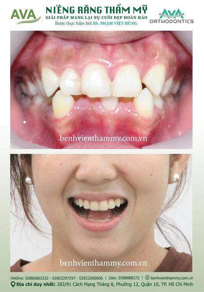 Kết quả niềng răng TPHCM trước và sau tại Nha khoa AVA Quận 10, ca 01