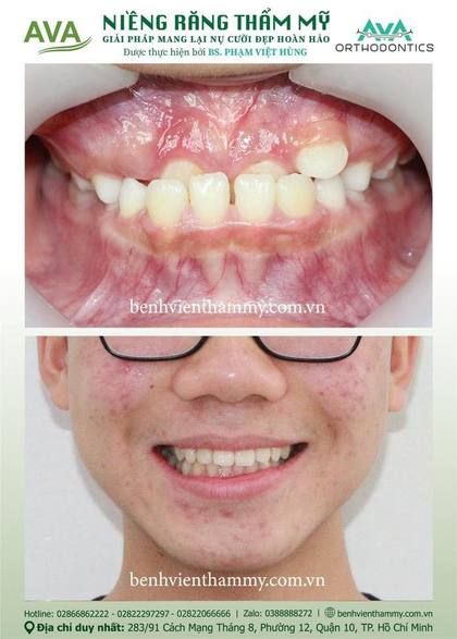 Ca niềng răng trả góp tphcm trước và sau điều trị tại Nha khoa AVA, ca 02