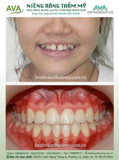 Hình ảnh trước và sau khi niềng răng – niềng răng trả góp quận 10 tại Nha khoa AVA, ca 03