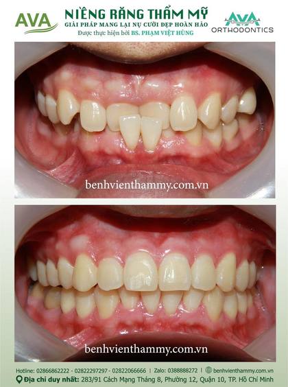Kết quả niềng răng TPHCM trước và sau tại Nha khoa AVA Quận 10, ca 04