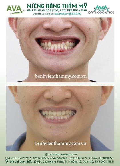 Hình ảnh trước và sau khi niềng răng – niềng răng trả góp quận 10 tại Nha khoa AVA, ca 06