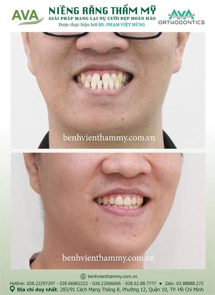 Kết quả niềng răng TPHCM trước và sau tại Nha khoa AVA Quận 10, ca 07