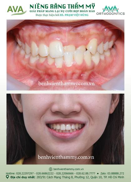 Ca niềng răng trả góp tphcm trước và sau điều trị tại Nha khoa AVA, ca 08
