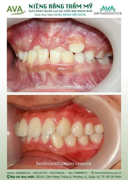 Hình ảnh trước và sau khi niềng răng – niềng răng trả góp quận 10 tại Nha khoa AVA, ca 09