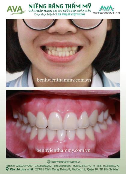 Kết quả niềng răng TPHCM trước và sau tại Nha khoa AVA Quận 10, ca 10