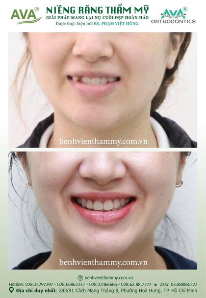 Kết quả niềng răng TPHCM trước và sau tại Nha khoa AVA Quận 10, ca 100