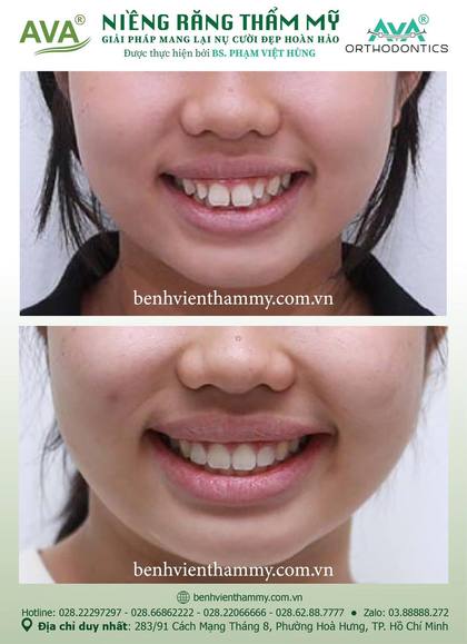 Ca niềng răng trả góp tphcm trước và sau điều trị tại Nha khoa AVA, ca 101
