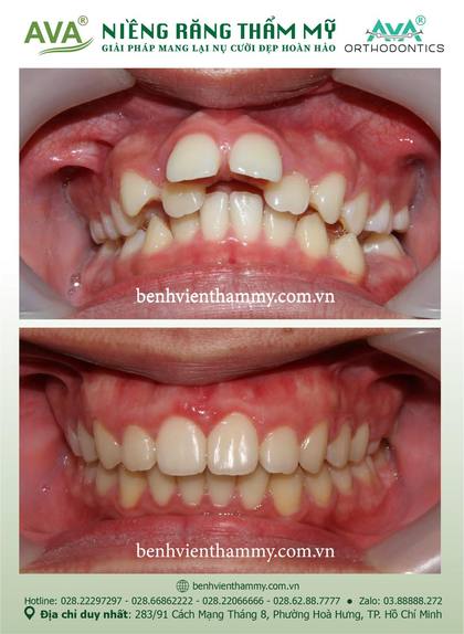 Hình ảnh trước và sau khi niềng răng – niềng răng trả góp quận 10 tại Nha khoa AVA, ca 102