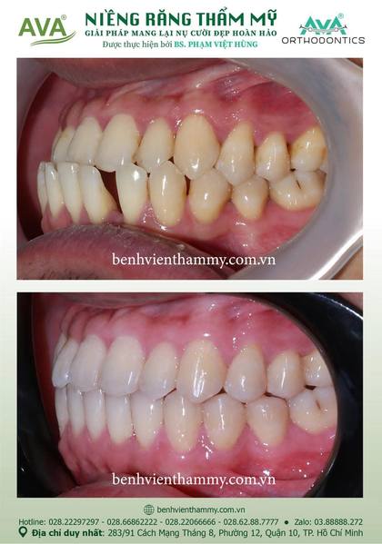 Kết quả niềng răng TPHCM trước và sau tại Nha khoa AVA Quận 10, ca 103