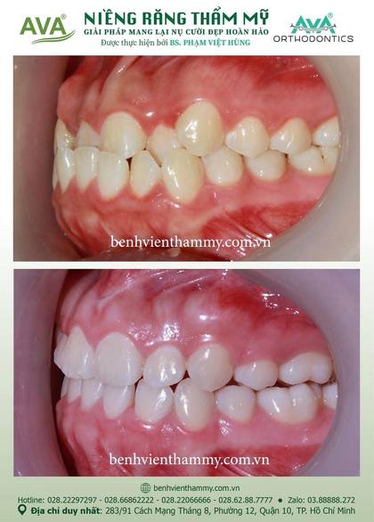 Ca niềng răng trả góp tphcm trước và sau điều trị tại Nha khoa AVA, ca 104