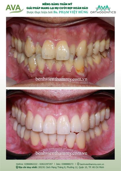 Hình ảnh trước và sau khi niềng răng – niềng răng trả góp quận 10 tại Nha khoa AVA, ca 105