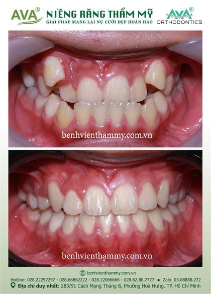 Ca niềng răng trả góp tphcm trước và sau điều trị tại Nha khoa AVA, ca 107