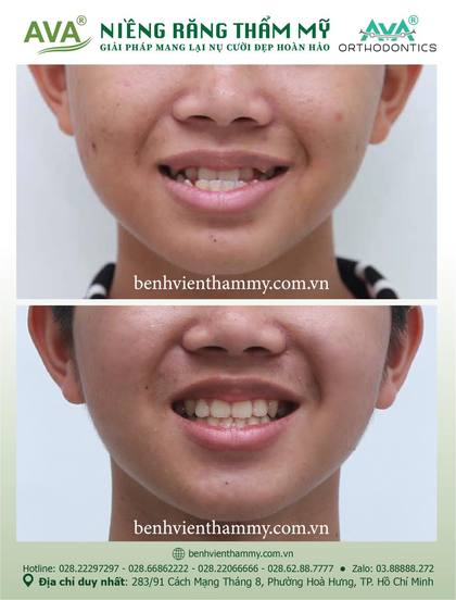 Kết quả niềng răng TPHCM trước và sau tại Nha khoa AVA Quận 10, ca 109