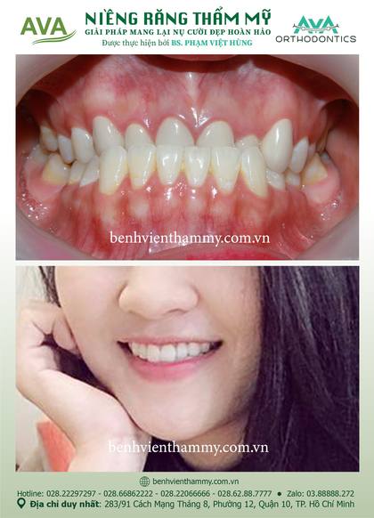 Ca niềng răng trả góp tphcm trước và sau điều trị tại Nha khoa AVA, ca 11
