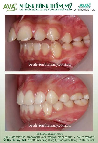 Ca niềng răng trả góp tphcm trước và sau điều trị tại Nha khoa AVA, ca 110