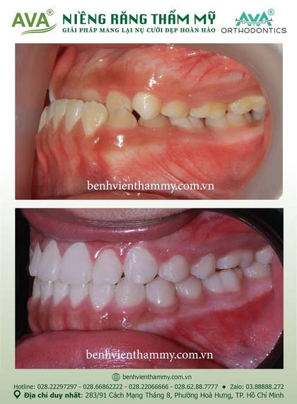 Hình ảnh trước và sau khi niềng răng – niềng răng trả góp quận 10 tại Nha khoa AVA, ca 111