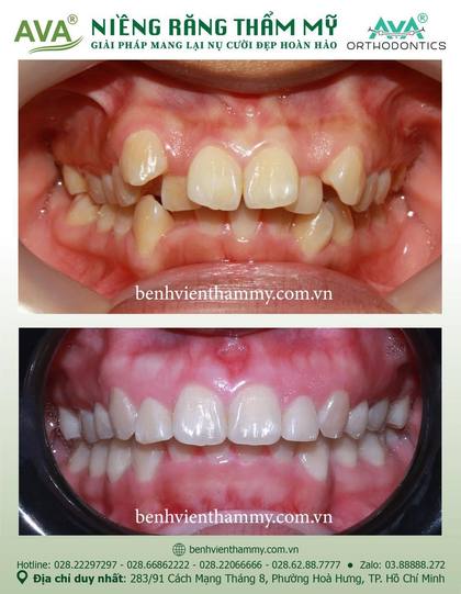 Kết quả niềng răng TPHCM trước và sau tại Nha khoa AVA Quận 10, ca 112