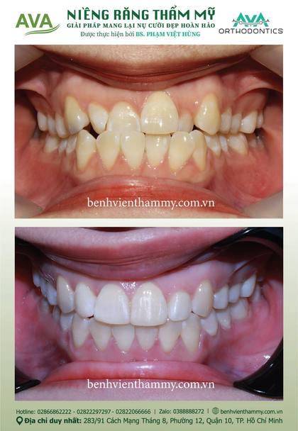 Ca niềng răng trả góp tphcm trước và sau điều trị tại Nha khoa AVA, ca 113