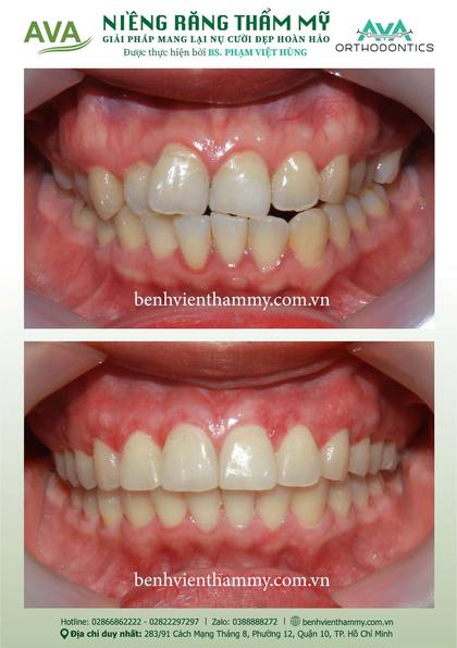 Kết quả niềng răng TPHCM trước và sau tại Nha khoa AVA Quận 10, ca 115