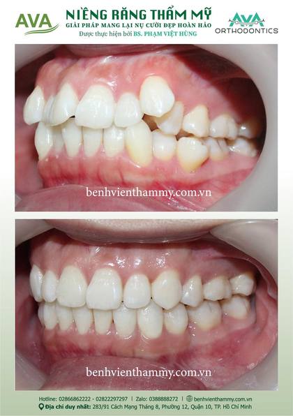 Ca niềng răng trả góp tphcm trước và sau điều trị tại Nha khoa AVA, ca 116
