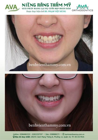 Hình ảnh trước và sau khi niềng răng – niềng răng trả góp quận 10 tại Nha khoa AVA, ca 117