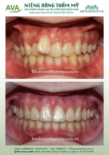 Kết quả niềng răng TPHCM trước và sau tại Nha khoa AVA Quận 10, ca 118