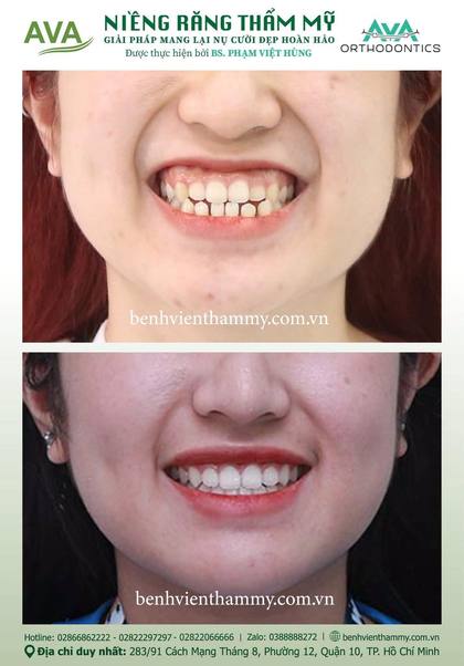 Ca niềng răng trả góp tphcm trước và sau điều trị tại Nha khoa AVA, ca 119