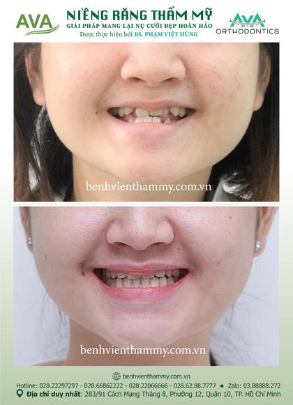 Hình ảnh trước và sau khi niềng răng – niềng răng trả góp quận 10 tại Nha khoa AVA, ca 12