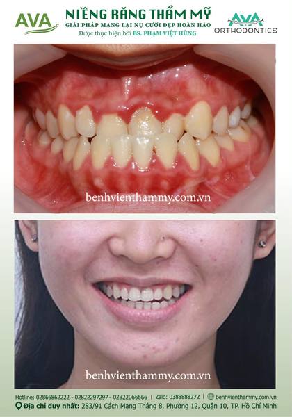 Hình ảnh trước và sau khi niềng răng – niềng răng trả góp quận 10 tại Nha khoa AVA, ca 120