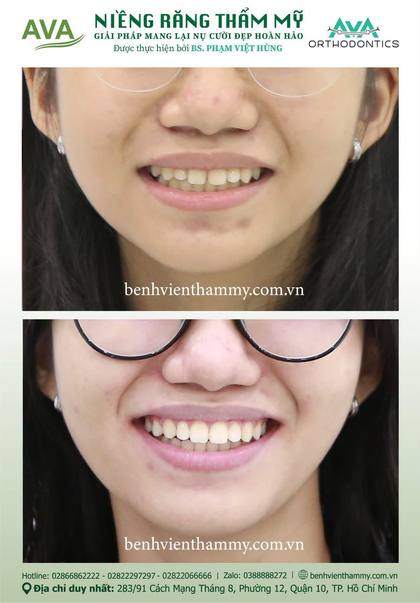 Kết quả niềng răng TPHCM trước và sau tại Nha khoa AVA Quận 10, ca 121