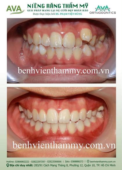 Ca niềng răng trả góp tphcm trước và sau điều trị tại Nha khoa AVA, ca 122