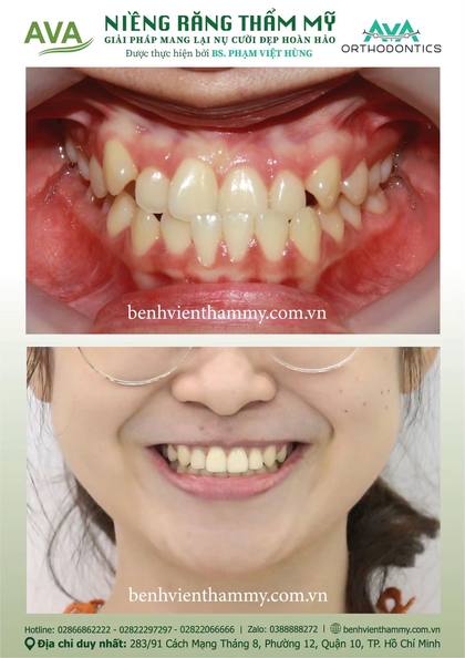 Hình ảnh trước và sau khi niềng răng – niềng răng trả góp quận 10 tại Nha khoa AVA, ca 123