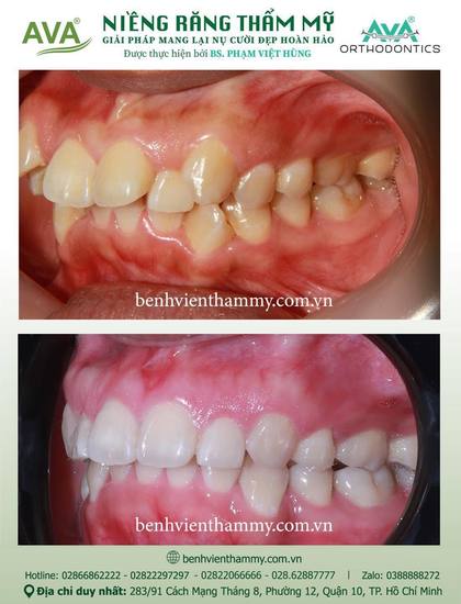 Kết quả niềng răng TPHCM trước và sau tại Nha khoa AVA Quận 10, ca 124