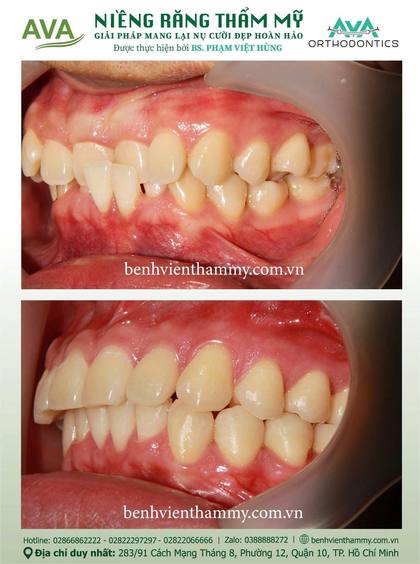 Ca niềng răng trả góp tphcm trước và sau điều trị tại Nha khoa AVA, ca 125