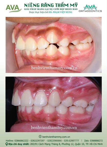 Kết quả niềng răng TPHCM trước và sau tại Nha khoa AVA Quận 10, ca 127