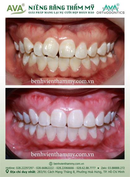 Ca niềng răng trả góp tphcm trước và sau điều trị tại Nha khoa AVA, ca 128
