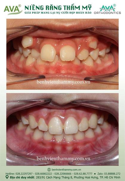Hình ảnh trước và sau khi niềng răng – niềng răng trả góp quận 10 tại Nha khoa AVA, ca 129