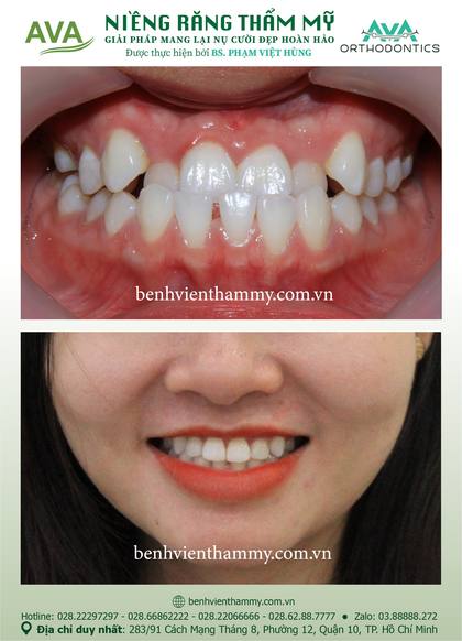 Niềng răng trả góp: điều kiện, thủ tục – Nha khoa AVA Quận 10