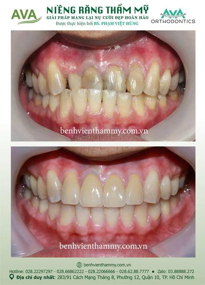 Kết quả niềng răng TPHCM trước và sau tại Nha khoa AVA Quận 10, ca 130