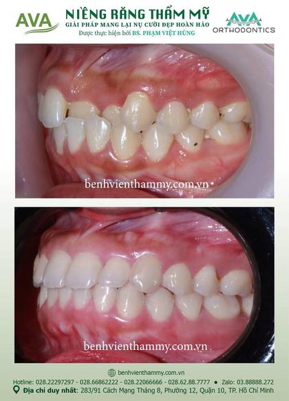 Ca niềng răng trả góp tphcm trước và sau điều trị tại Nha khoa AVA, ca 131