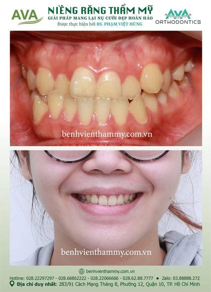 Hình ảnh trước và sau khi niềng răng – niềng răng trả góp quận 10 tại Nha khoa AVA, ca 132