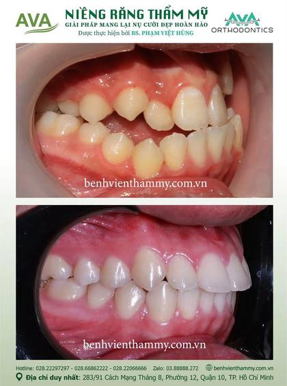 Kết quả niềng răng TPHCM trước và sau tại Nha khoa AVA Quận 10, ca 133