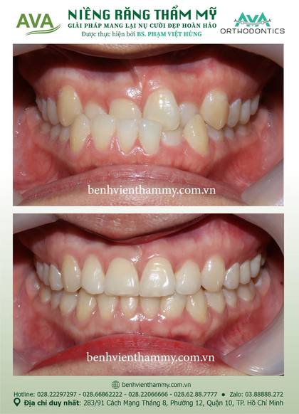 Ca niềng răng trả góp tphcm trước và sau điều trị tại Nha khoa AVA, ca 134