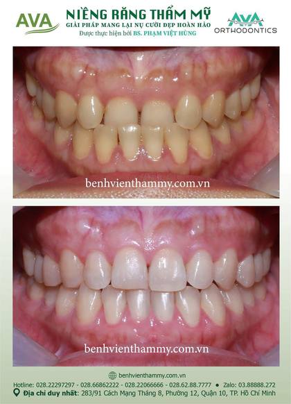 Hình ảnh trước và sau khi niềng răng – niềng răng trả góp quận 10 tại Nha khoa AVA, ca 135