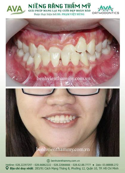 Kết quả niềng răng TPHCM trước và sau tại Nha khoa AVA Quận 10, ca 136