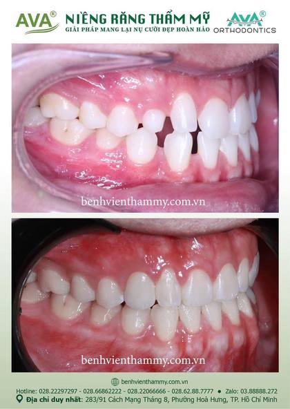 Ca niềng răng trả góp tphcm trước và sau điều trị tại Nha khoa AVA, ca 137