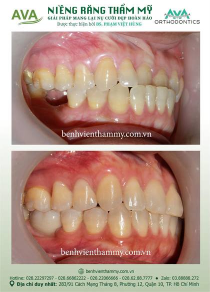 Hình ảnh trước và sau khi niềng răng – niềng răng trả góp quận 10 tại Nha khoa AVA, ca 138