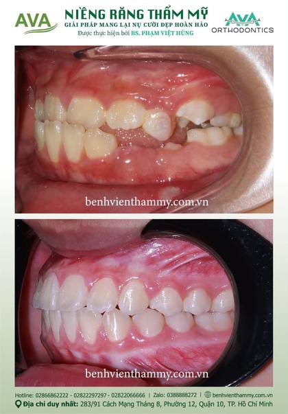 Kết quả niềng răng TPHCM trước và sau tại Nha khoa AVA Quận 10, ca 139