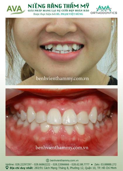 Ca niềng răng trả góp tphcm trước và sau điều trị tại Nha khoa AVA, ca 14