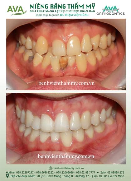 Ca niềng răng trả góp tphcm trước và sau điều trị tại Nha khoa AVA, ca 140